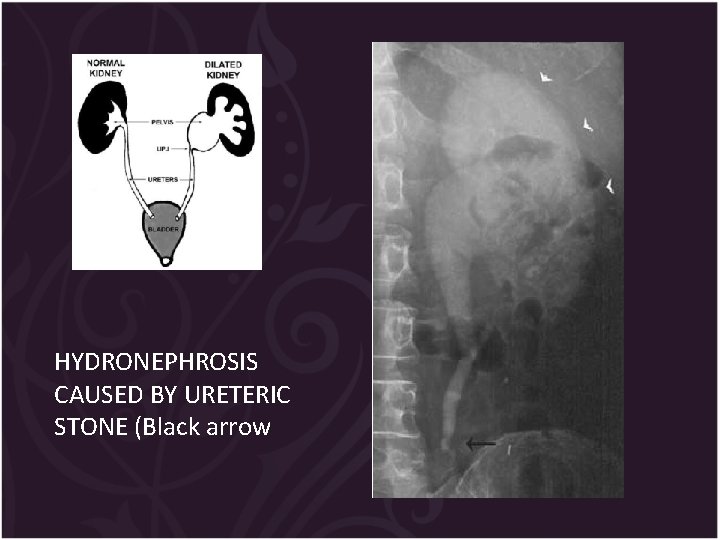 HYDRONEPHROSIS CAUSED BY URETERIC STONE (Black arrow 