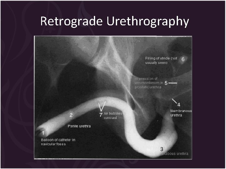 Retrograde Urethrography 