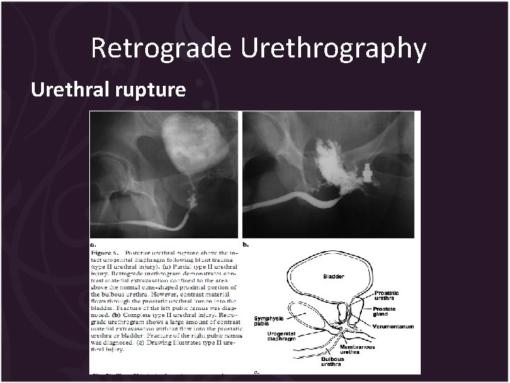 Retrograde Urethrography Urethral rupture 