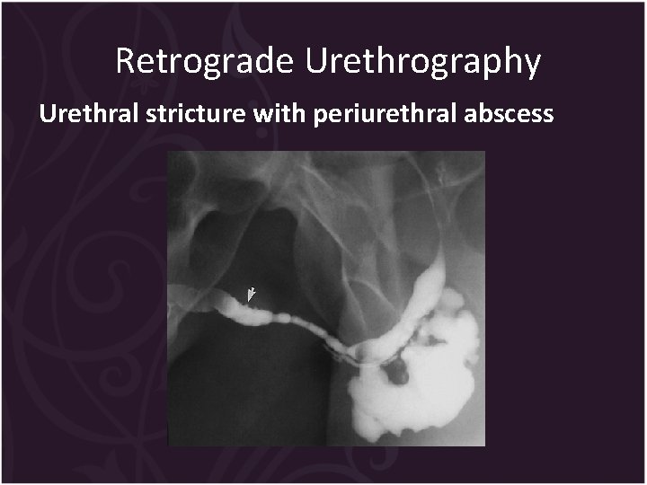 Retrograde Urethrography Urethral stricture with periurethral abscess 