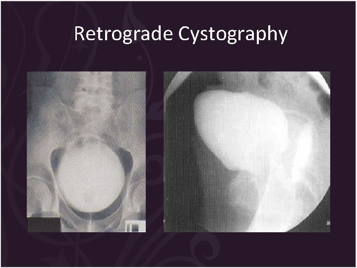 Retrograde Cystography 