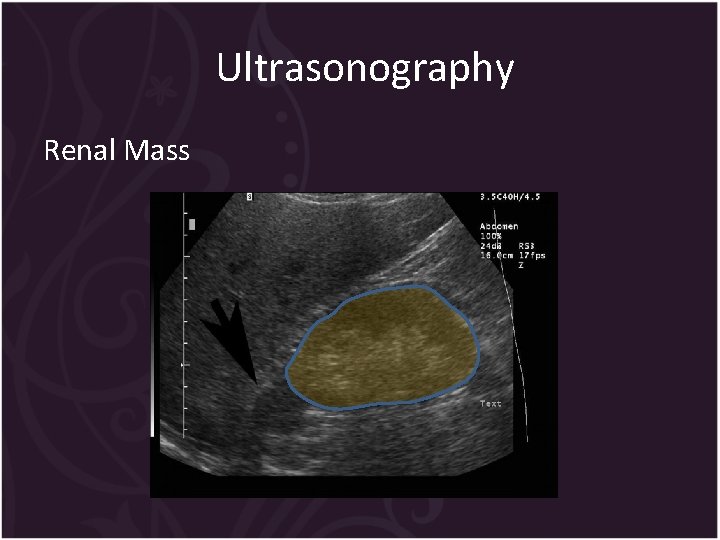 Ultrasonography Renal Mass 