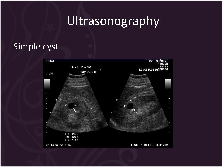 Ultrasonography Simple cyst 
