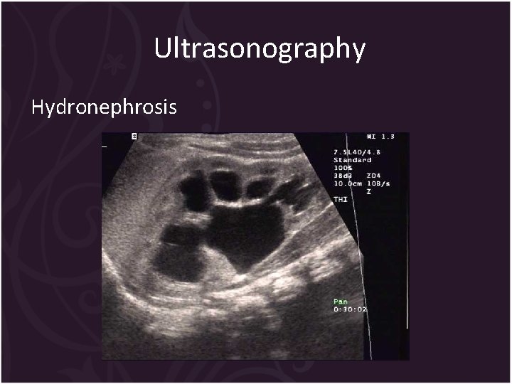 Ultrasonography Hydronephrosis 