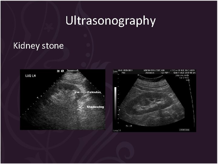Ultrasonography Kidney stone 