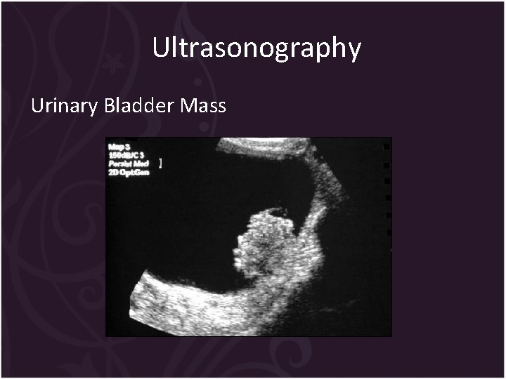 Ultrasonography Urinary Bladder Mass 