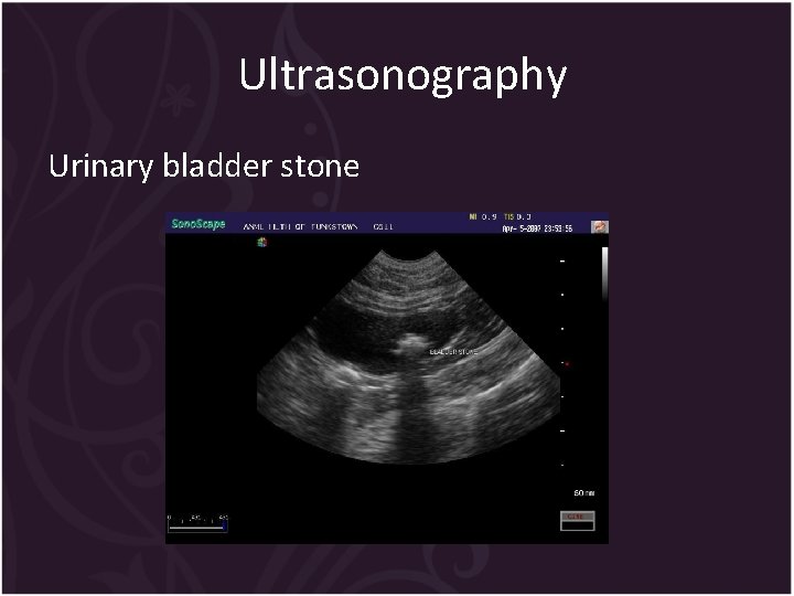 Ultrasonography Urinary bladder stone 