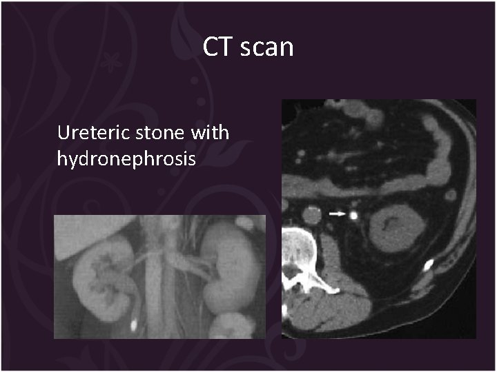 CT scan Ureteric stone with hydronephrosis 