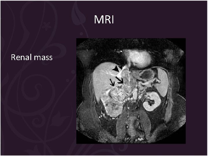 MRI Renal mass 