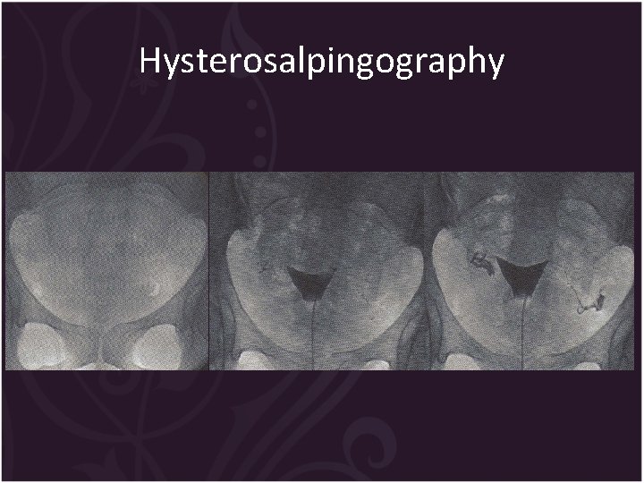 Hysterosalpingography 