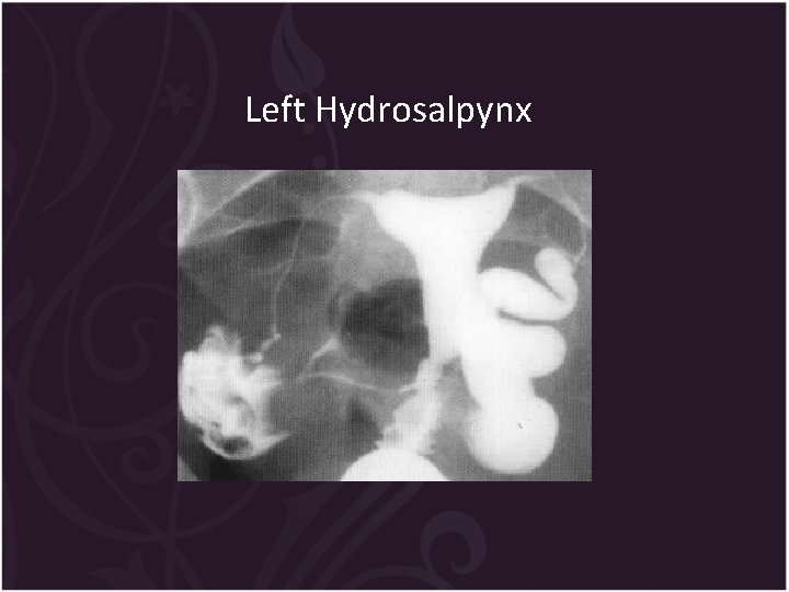 Left Hydrosalpynx 