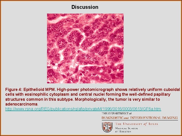 Discussion Figure 4: Epithelioid MPM. High-power photomicrograph shows relatively uniform cuboidal cells with eosinophilic