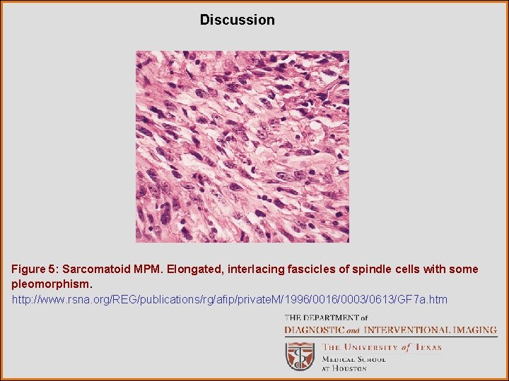 Discussion Figure 5: Sarcomatoid MPM. Elongated, interlacing fascicles of spindle cells with some pleomorphism.