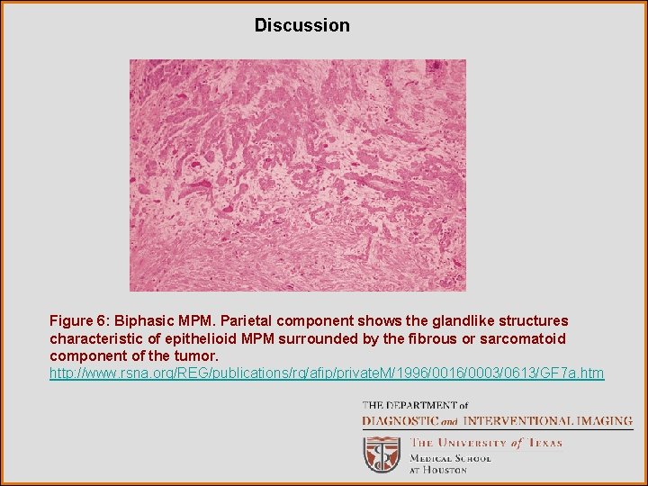 Discussion Figure 6: Biphasic MPM. Parietal component shows the glandlike structures characteristic of epithelioid