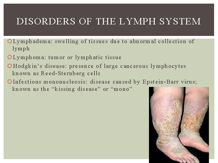 DISORDERS OF THE LYMPH SYSTEM Lymphadema: swelling of tissues due to abnormal collection of