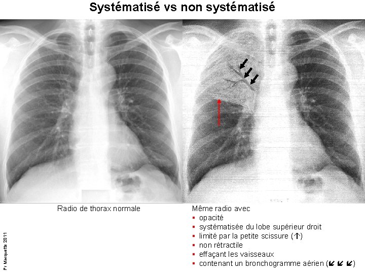 Systématisé vs non systématisé Pr Marquette 2011 Radio de thorax normale Même radio avec Systématisé vs non systématisé Pr Marquette 2011 Radio de thorax normale Même radio avec