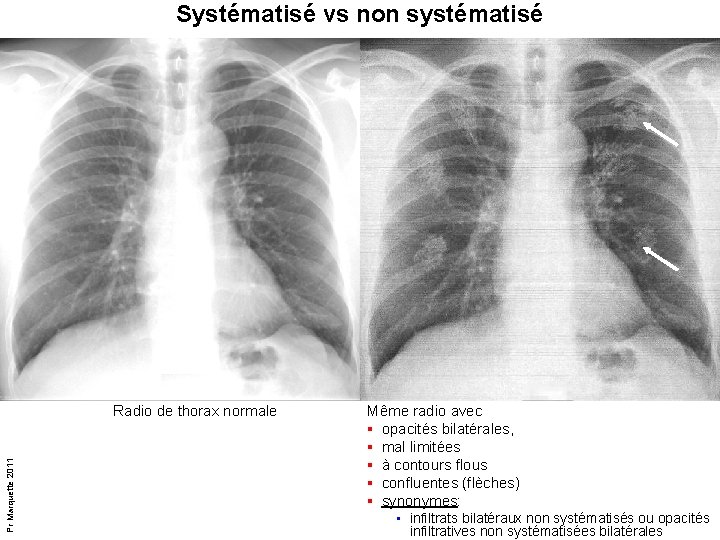 Systématisé vs non systématisé Pr Marquette 2011 Radio de thorax normale Même radio avec Systématisé vs non systématisé Pr Marquette 2011 Radio de thorax normale Même radio avec