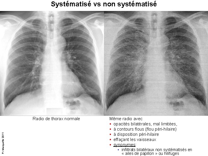Systématisé vs non systématisé Pr Marquette 2011 Radio de thorax normale Même radio avec Systématisé vs non systématisé Pr Marquette 2011 Radio de thorax normale Même radio avec