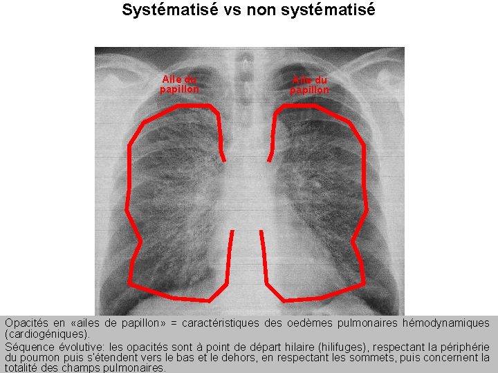 Systématisé vs non systématisé Pr Marquette 2011 Aile du papillon Opacités en «ailes de Systématisé vs non systématisé Pr Marquette 2011 Aile du papillon Opacités en «ailes de