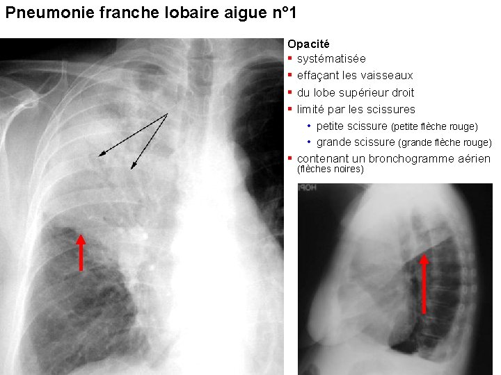 Pneumonie franche lobaire aigue n° 1 Opacité § systématisée § effaçant les vaisseaux § Pneumonie franche lobaire aigue n° 1 Opacité § systématisée § effaçant les vaisseaux §