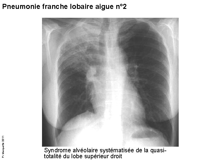 Pr Marquette 2011 Pneumonie franche lobaire aigue n° 2 Syndrome alvéolaire systématisée de la Pr Marquette 2011 Pneumonie franche lobaire aigue n° 2 Syndrome alvéolaire systématisée de la