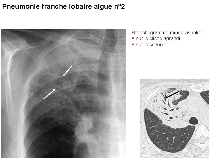 Pneumonie franche lobaire aigue n° 2 Bronchogramme mieux visualisé § sur le cliché agrandi Pneumonie franche lobaire aigue n° 2 Bronchogramme mieux visualisé § sur le cliché agrandi
