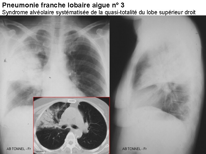 Pneumonie franche lobaire aigue n° 3 Syndrome alvéolaire systématisée de la quasi-totalité du lobe Pneumonie franche lobaire aigue n° 3 Syndrome alvéolaire systématisée de la quasi-totalité du lobe