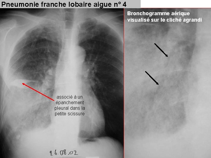 Pneumonie franche lobaire aigue n° 4 Bronchogramme aérique visualisé sur le cliché agrandi associé Pneumonie franche lobaire aigue n° 4 Bronchogramme aérique visualisé sur le cliché agrandi associé