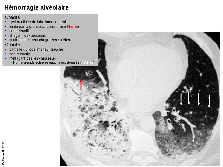Hémorragie alvéolaire Opacité • • • systématisée du lobe inférieur droit limité par la Hémorragie alvéolaire Opacité • • • systématisée du lobe inférieur droit limité par la
