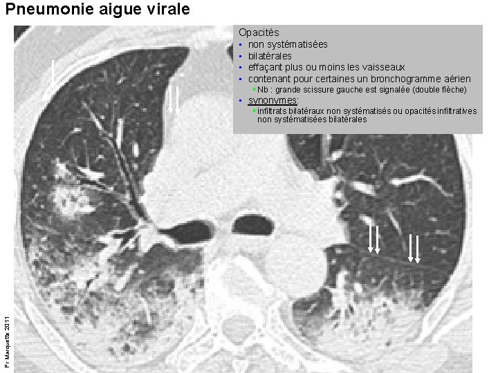 Pneumonie aigue virale Opacités • non systématisées • bilatérales • effaçant plus ou moins Pneumonie aigue virale Opacités • non systématisées • bilatérales • effaçant plus ou moins