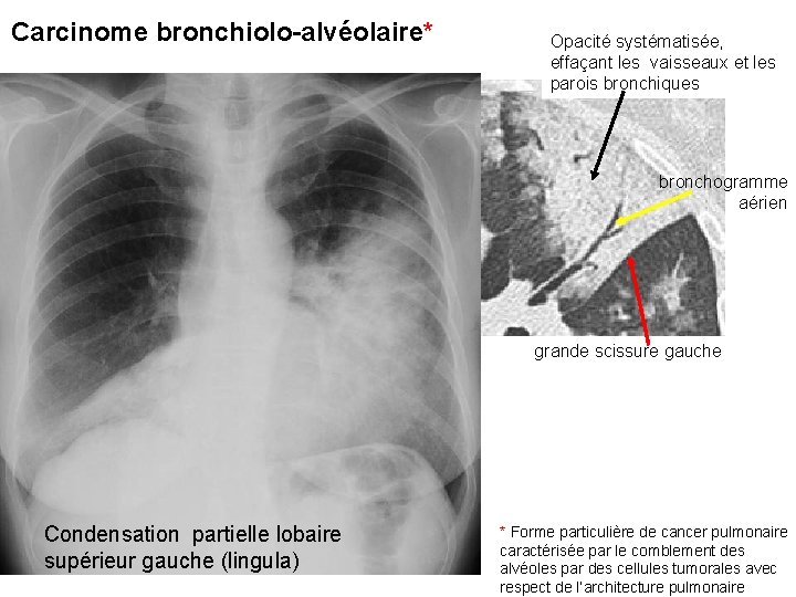 Carcinome bronchiolo-alvéolaire* Opacité systématisée, effaçant les vaisseaux et les parois bronchiques bronchogramme aérien grande Carcinome bronchiolo-alvéolaire* Opacité systématisée, effaçant les vaisseaux et les parois bronchiques bronchogramme aérien grande
