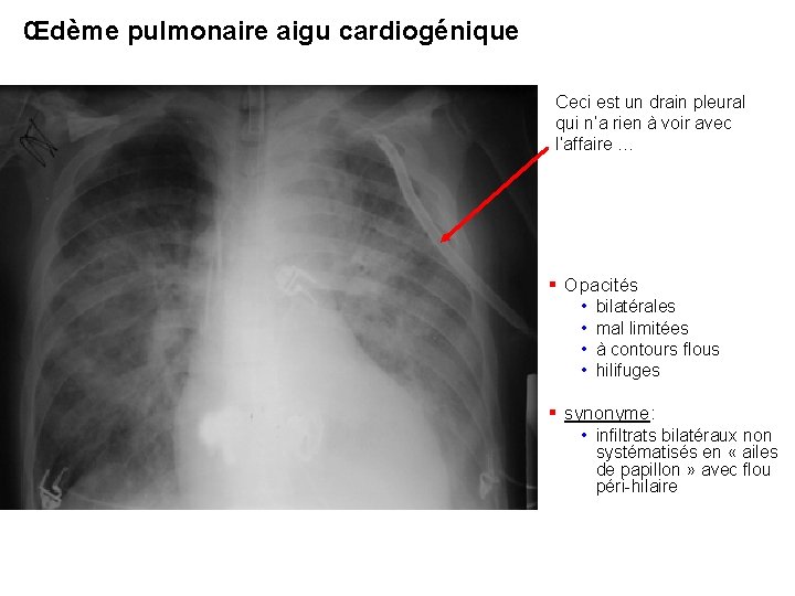 Œdème pulmonaire aigu cardiogénique Ceci est un drain pleural qui n’a rien à voir Œdème pulmonaire aigu cardiogénique Ceci est un drain pleural qui n’a rien à voir