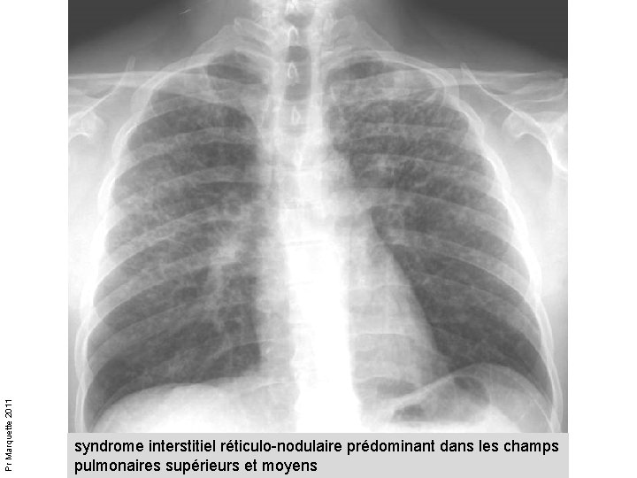 Pr Marquette 2011 syndrome interstitiel réticulo-nodulaire prédominant dans les champs pulmonaires supérieurs et moyens Pr Marquette 2011 syndrome interstitiel réticulo-nodulaire prédominant dans les champs pulmonaires supérieurs et moyens