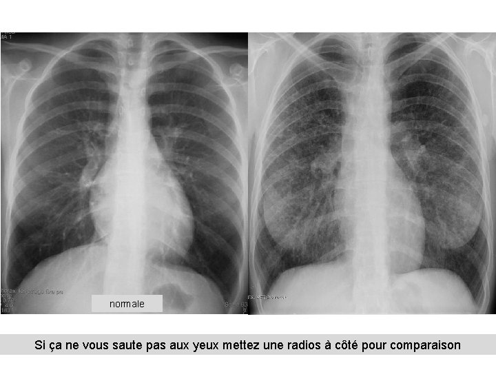 normale Si ça ne vous saute pas aux yeux mettez une radios à côté normale Si ça ne vous saute pas aux yeux mettez une radios à côté