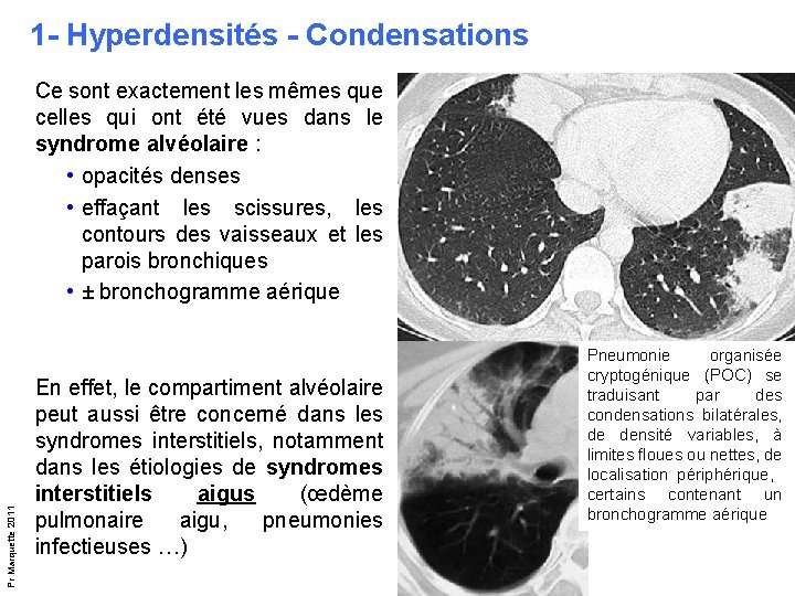 1 - Hyperdensités - Condensations Pr Marquette 2011 Ce sont exactement les mêmes que 1 - Hyperdensités - Condensations Pr Marquette 2011 Ce sont exactement les mêmes que