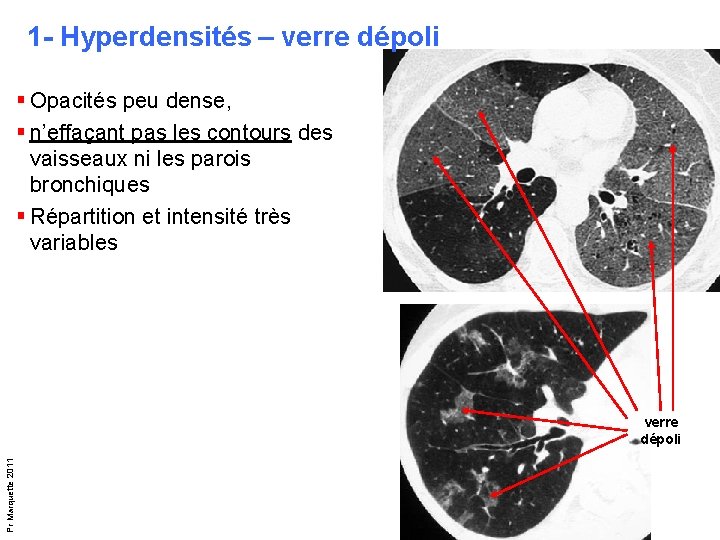 1 - Hyperdensités – verre dépoli § Opacités peu dense, § n’effaçant pas les 1 - Hyperdensités – verre dépoli § Opacités peu dense, § n’effaçant pas les