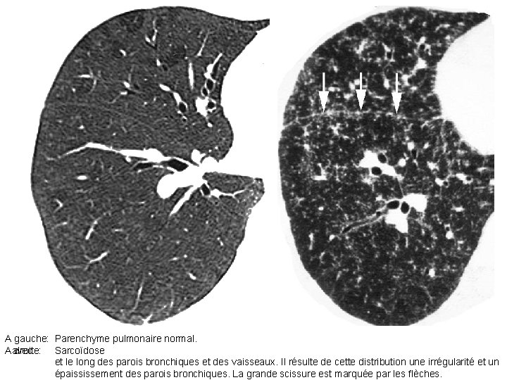 A gauche: Parenchyme pulmonaire normal. A droite: avec Sarcoïdose et le long des parois A gauche: Parenchyme pulmonaire normal. A droite: avec Sarcoïdose et le long des parois