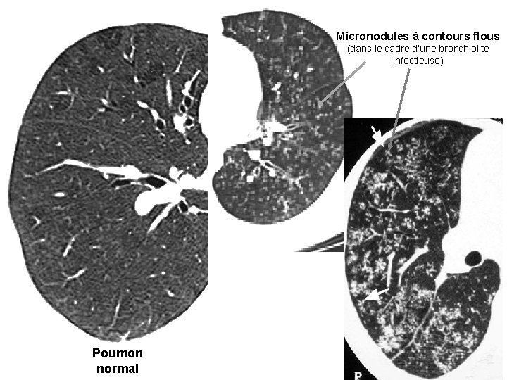 Micronodules à contours flous (dans le cadre d’une bronchiolite infectieuse) Poumon normal Micronodules à contours flous (dans le cadre d’une bronchiolite infectieuse) Poumon normal