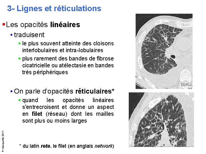 3 - Lignes et réticulations § Les opacités linéaires • traduisent § le plus 3 - Lignes et réticulations § Les opacités linéaires • traduisent § le plus