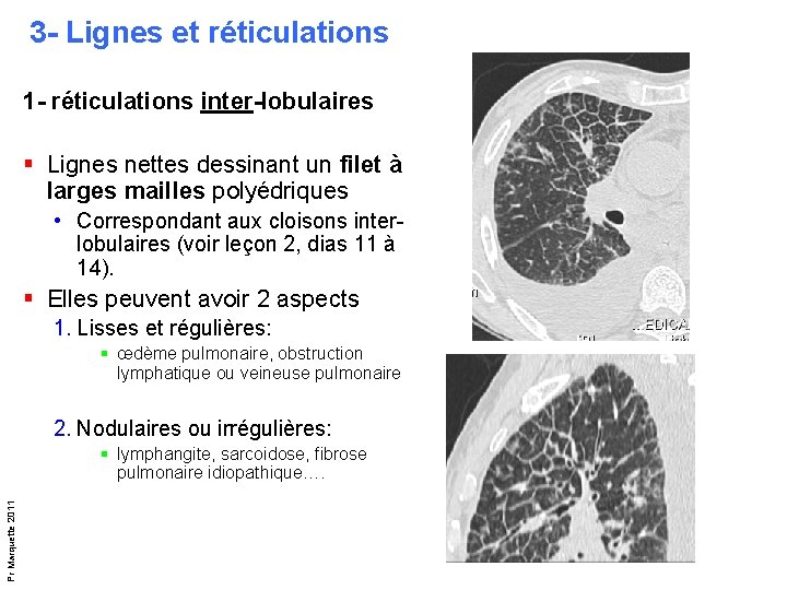 3 - Lignes et réticulations 1 - réticulations inter-lobulaires § Lignes nettes dessinant un 3 - Lignes et réticulations 1 - réticulations inter-lobulaires § Lignes nettes dessinant un