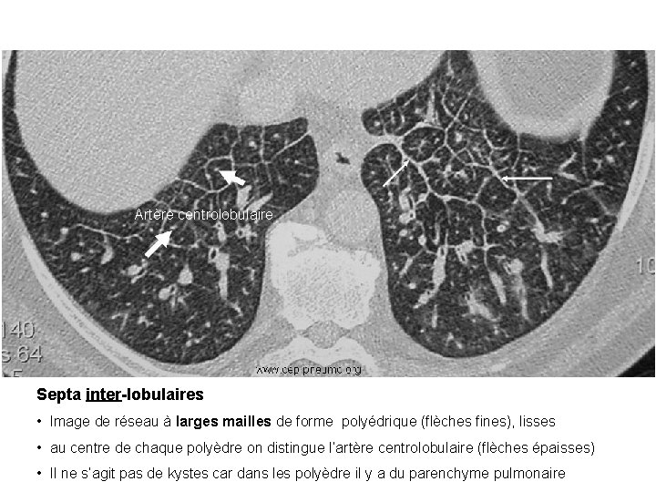 Artère centrolobulaire Septa inter-lobulaires • Image de réseau à larges mailles de forme polyédrique Artère centrolobulaire Septa inter-lobulaires • Image de réseau à larges mailles de forme polyédrique