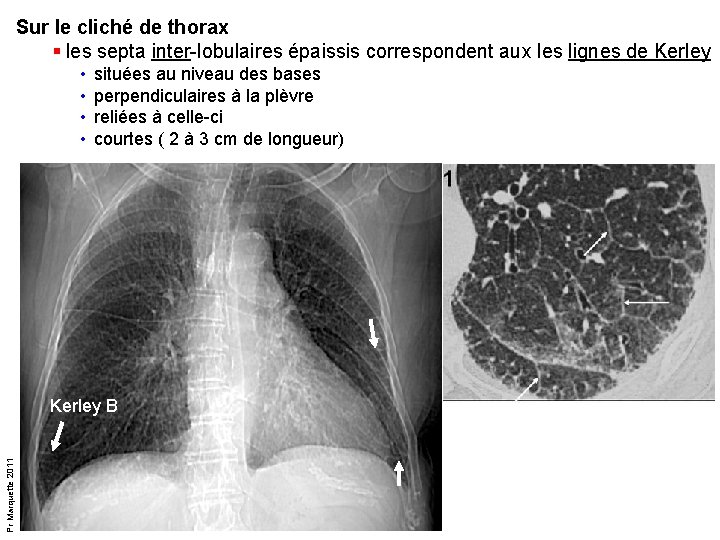 Sur le cliché de thorax § les septa inter-lobulaires épaissis correspondent aux les lignes Sur le cliché de thorax § les septa inter-lobulaires épaissis correspondent aux les lignes