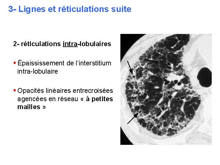 3 - Lignes et réticulations suite 2 - réticulations intra-lobulaires § Épaississement de l’interstitium 3 - Lignes et réticulations suite 2 - réticulations intra-lobulaires § Épaississement de l’interstitium