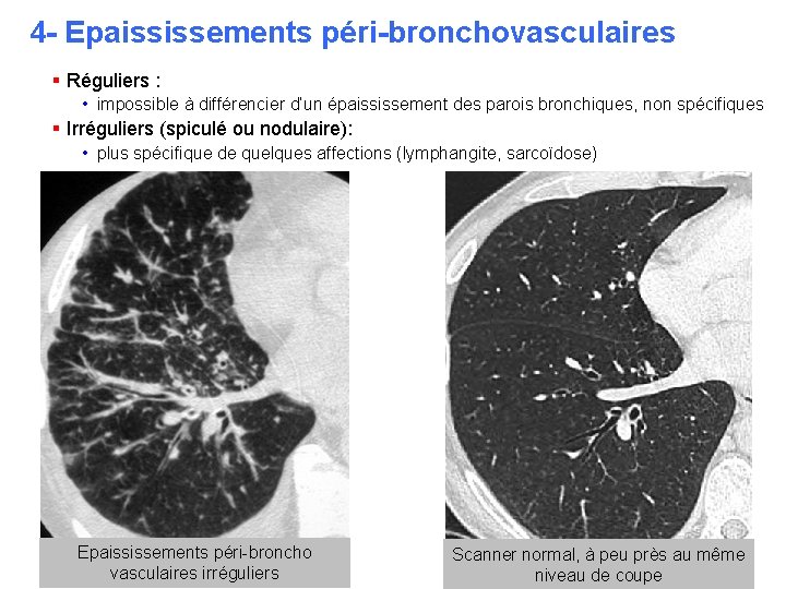 4 - Epaississements péri-bronchovasculaires § Réguliers : • impossible à différencier d’un épaississement des 4 - Epaississements péri-bronchovasculaires § Réguliers : • impossible à différencier d’un épaississement des