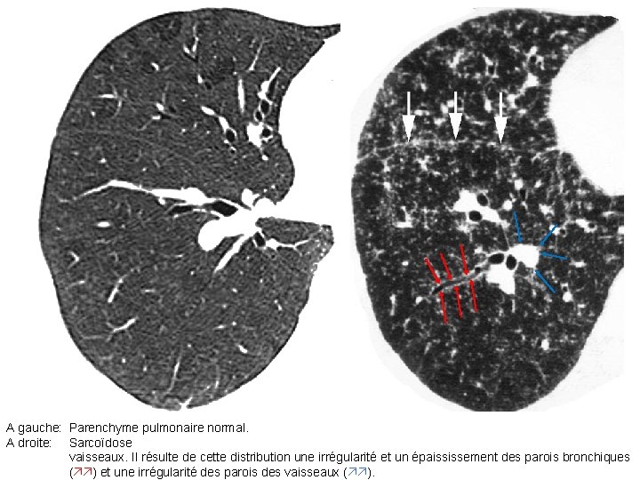 A gauche: Parenchyme pulmonaire normal. A droite: Sarcoïdose vaisseaux. Il résulte de cette distribution A gauche: Parenchyme pulmonaire normal. A droite: Sarcoïdose vaisseaux. Il résulte de cette distribution