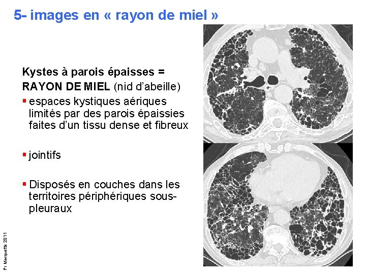 5 - images en « rayon de miel » Kystes à parois épaisses = 5 - images en « rayon de miel » Kystes à parois épaisses =