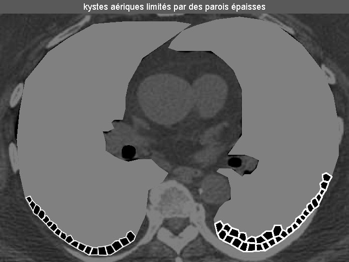 kystes aériques limités par des parois épaisses kystes aériques limités par des parois épaisses