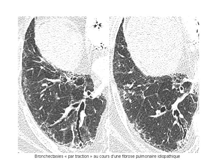Bronchectasies « par traction » au cours d’une fibrose pulmonaire idiopathique Bronchectasies « par traction » au cours d’une fibrose pulmonaire idiopathique