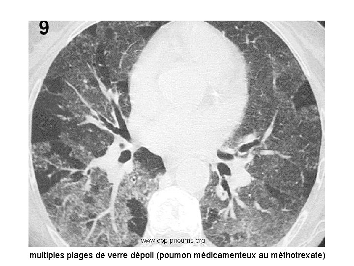 multiples plages de verre dépoli (poumon médicamenteux au méthotrexate) multiples plages de verre dépoli (poumon médicamenteux au méthotrexate)