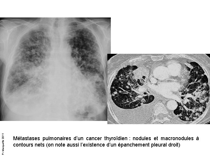 Pr Marquette 2011 Métastases pulmonaires d’un cancer thyroïdien : nodules et macronodules à contours Pr Marquette 2011 Métastases pulmonaires d’un cancer thyroïdien : nodules et macronodules à contours